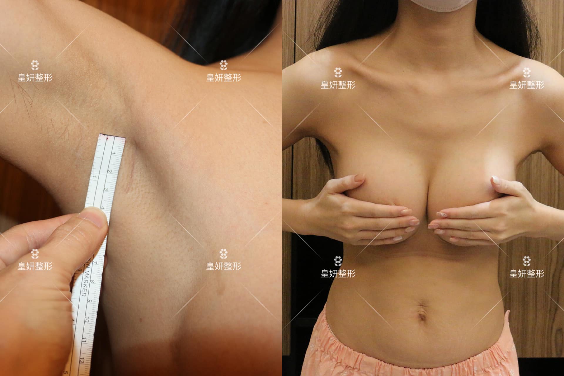 魔滴隆乳手術推薦