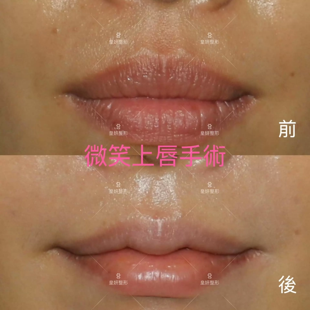 縮唇,微笑縮唇手術