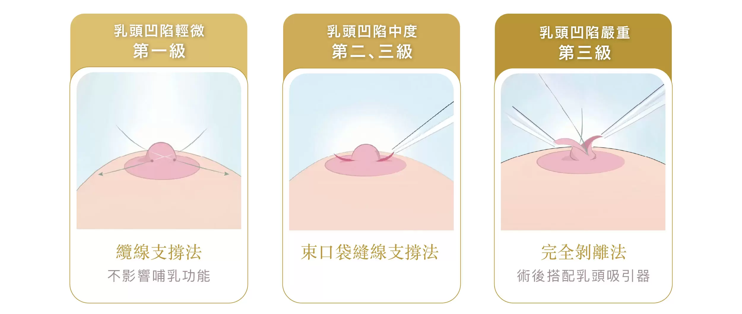 乳頭凹陷 09