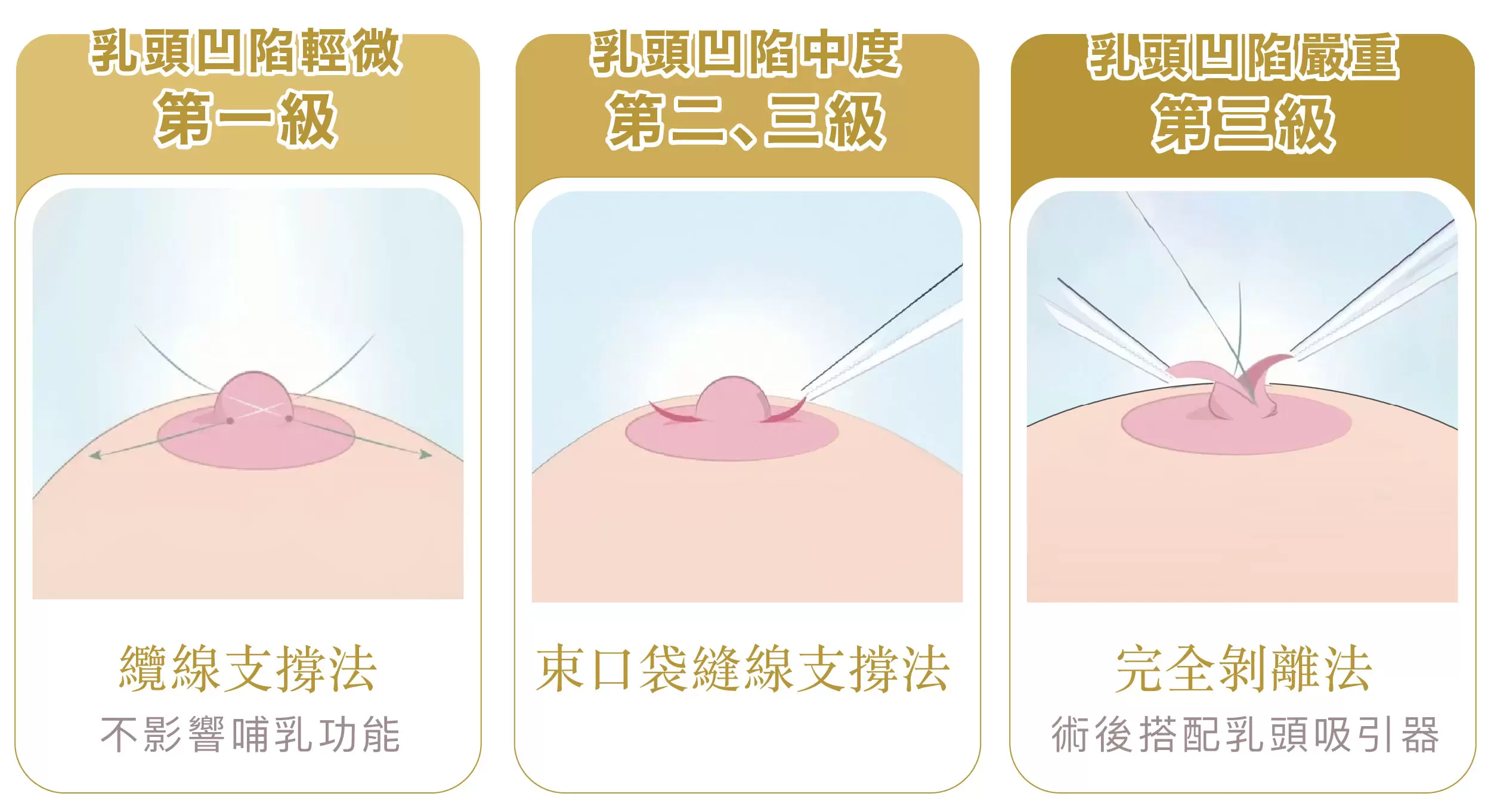 乳頭凹陷-皇妍胸部整形