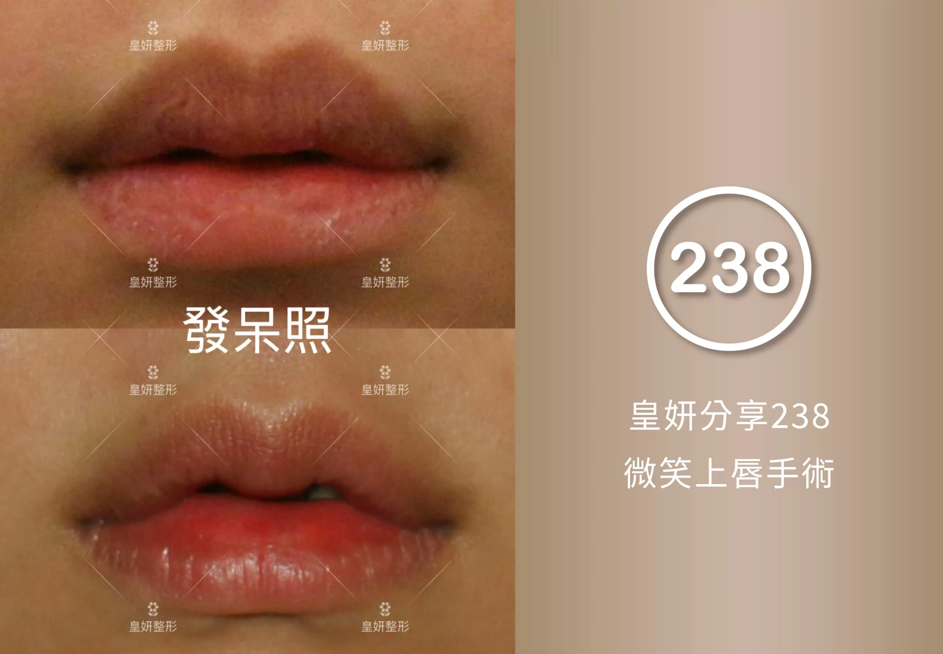 238
