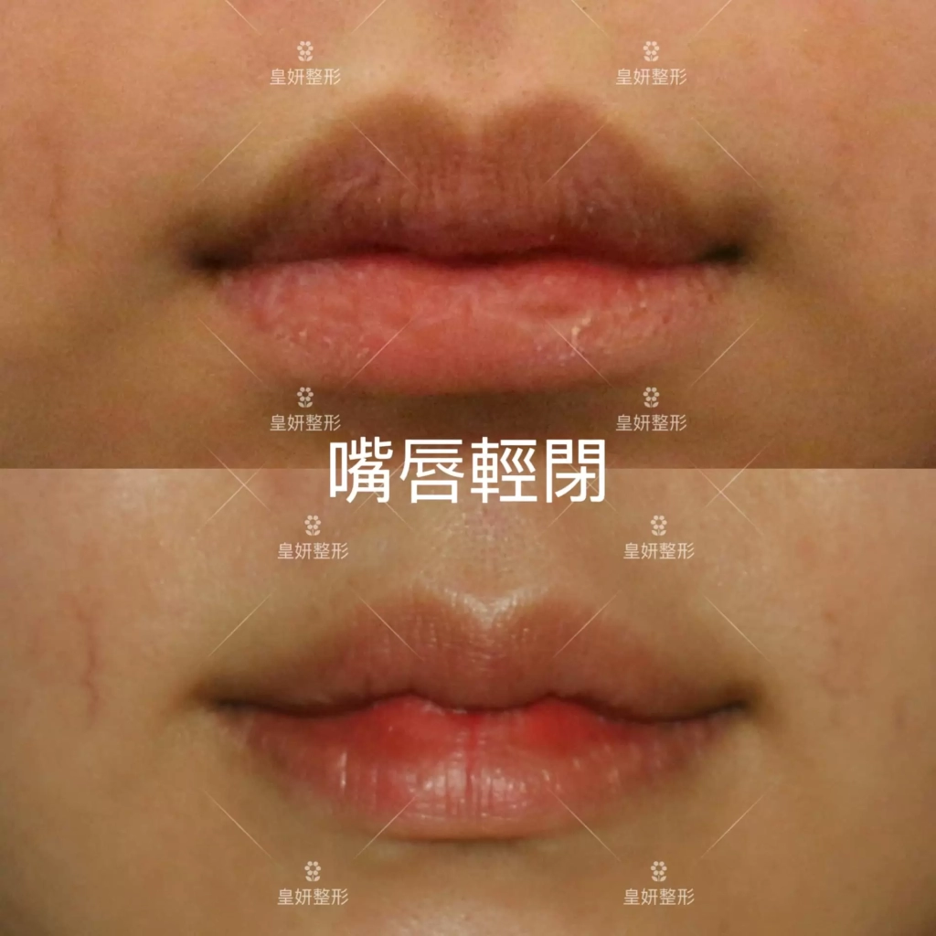 縮唇,微笑縮唇手術