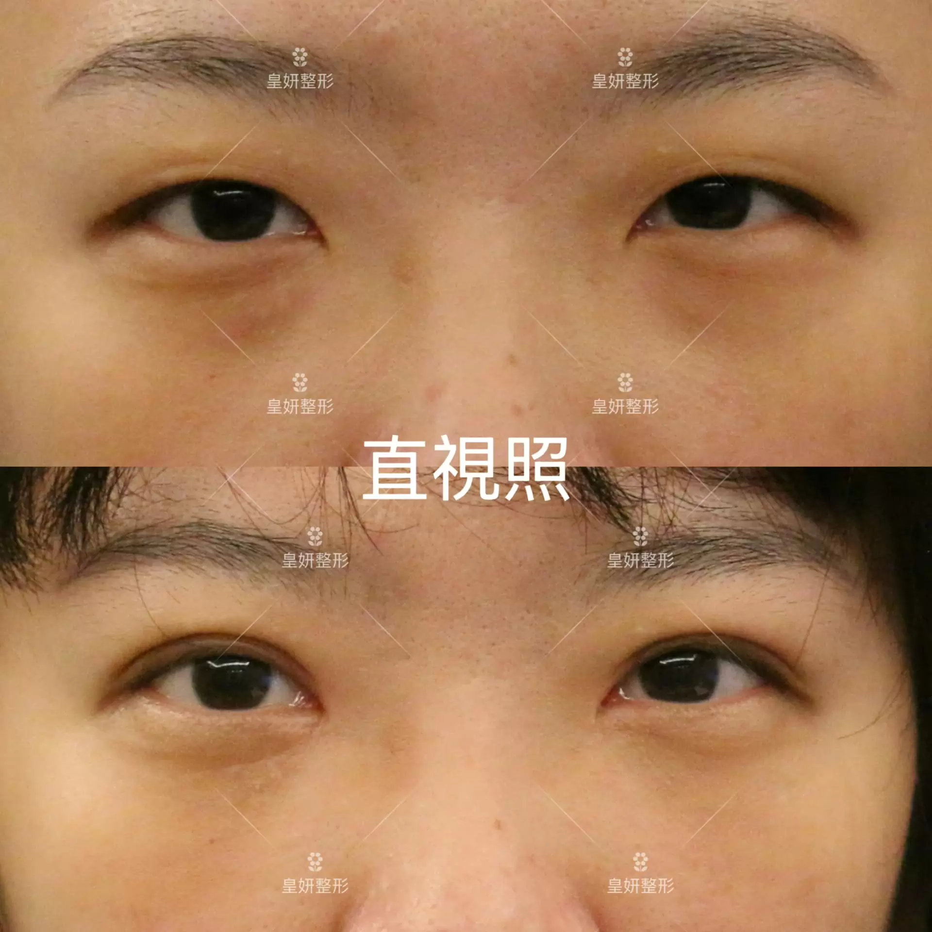 縫雙眼皮+開眼頭+眼袋手術