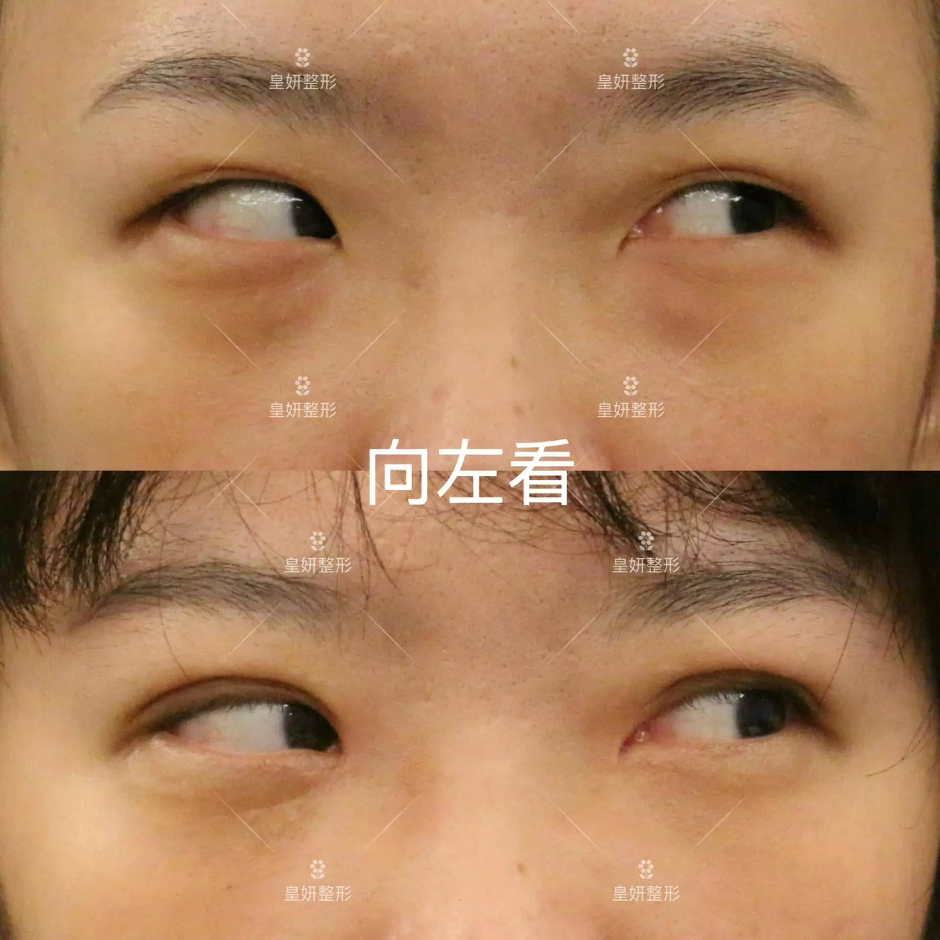 縫雙眼皮+開眼頭+眼袋手術