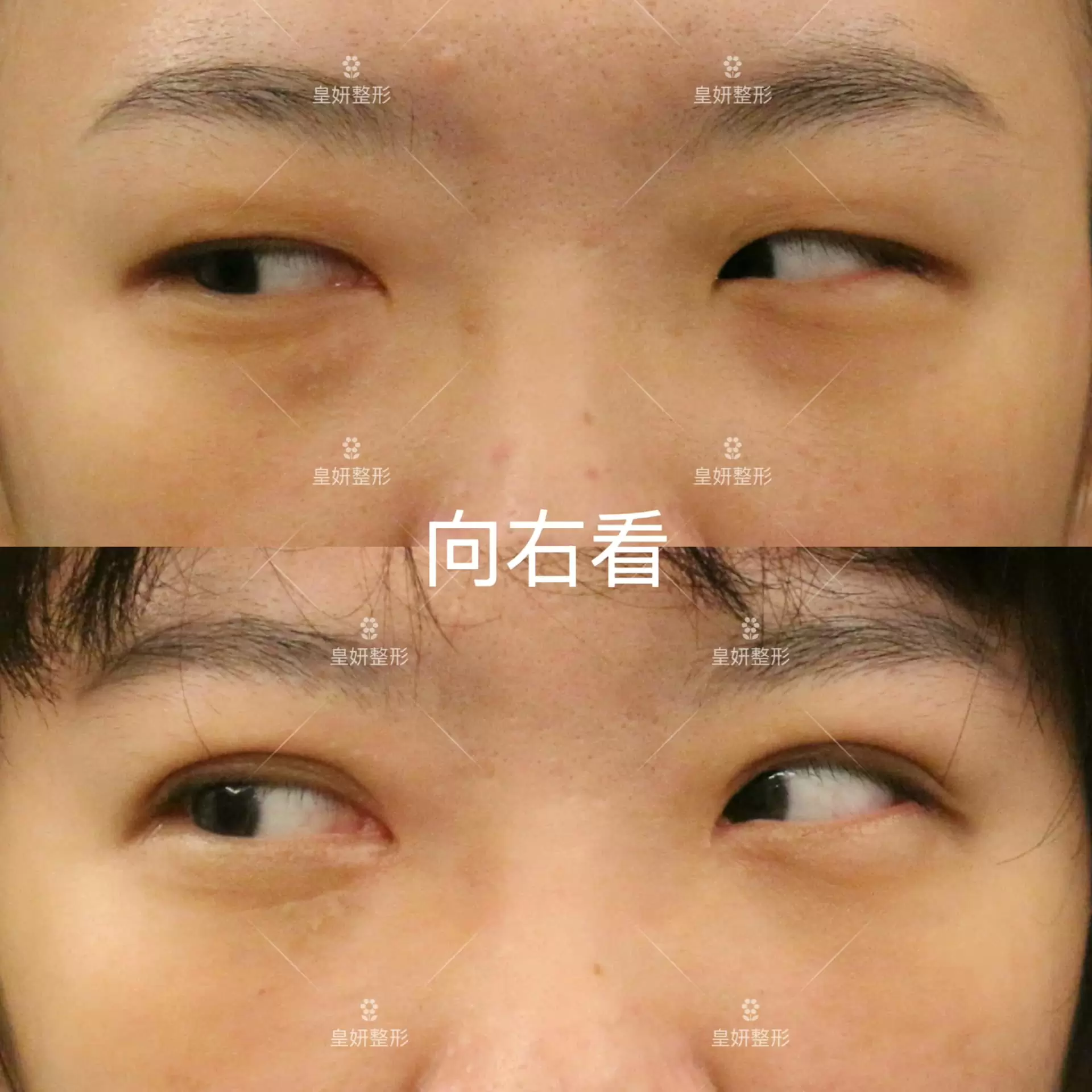 縫雙眼皮+開眼頭+眼袋手術